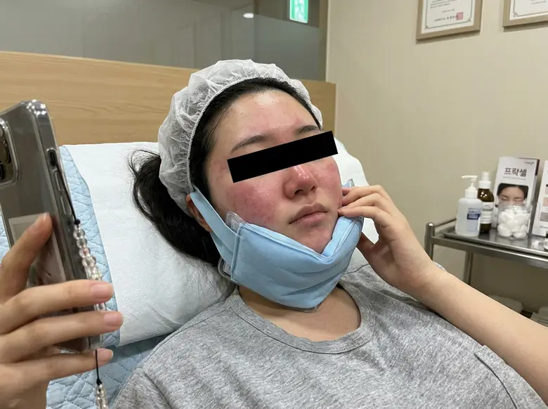 피부과 여드름 흉터 프락셀 레이저 부작용 얼굴 불타는 고구마 돼서 마스크 쓴 썰.jpg